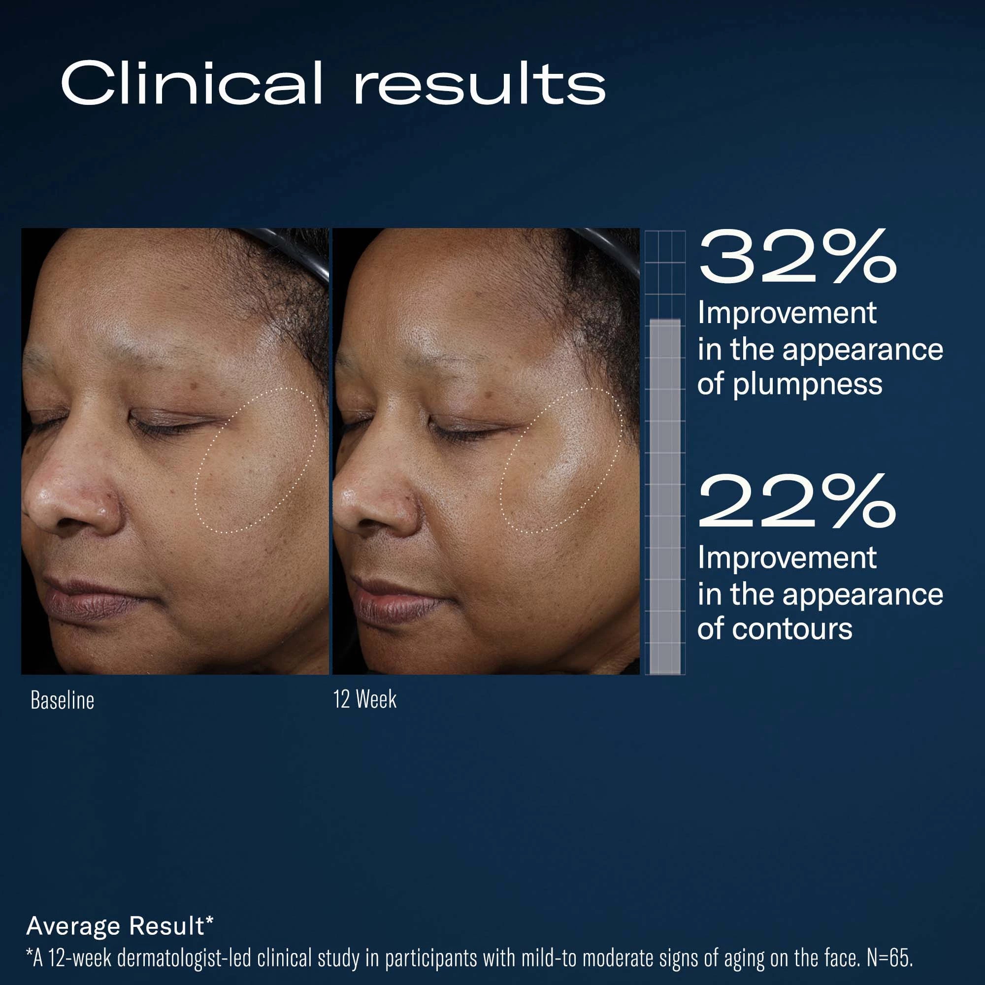 Ampra Volumizing Macro HA Serum clinical results