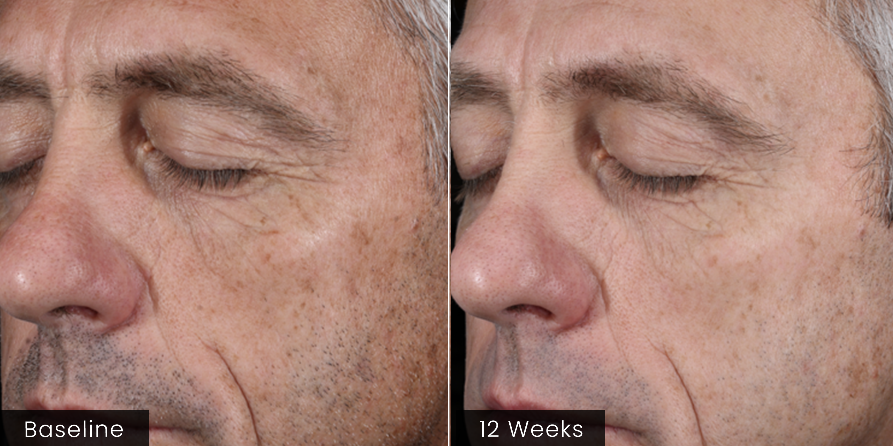 ( plated ) INTENSE Serum before and after results