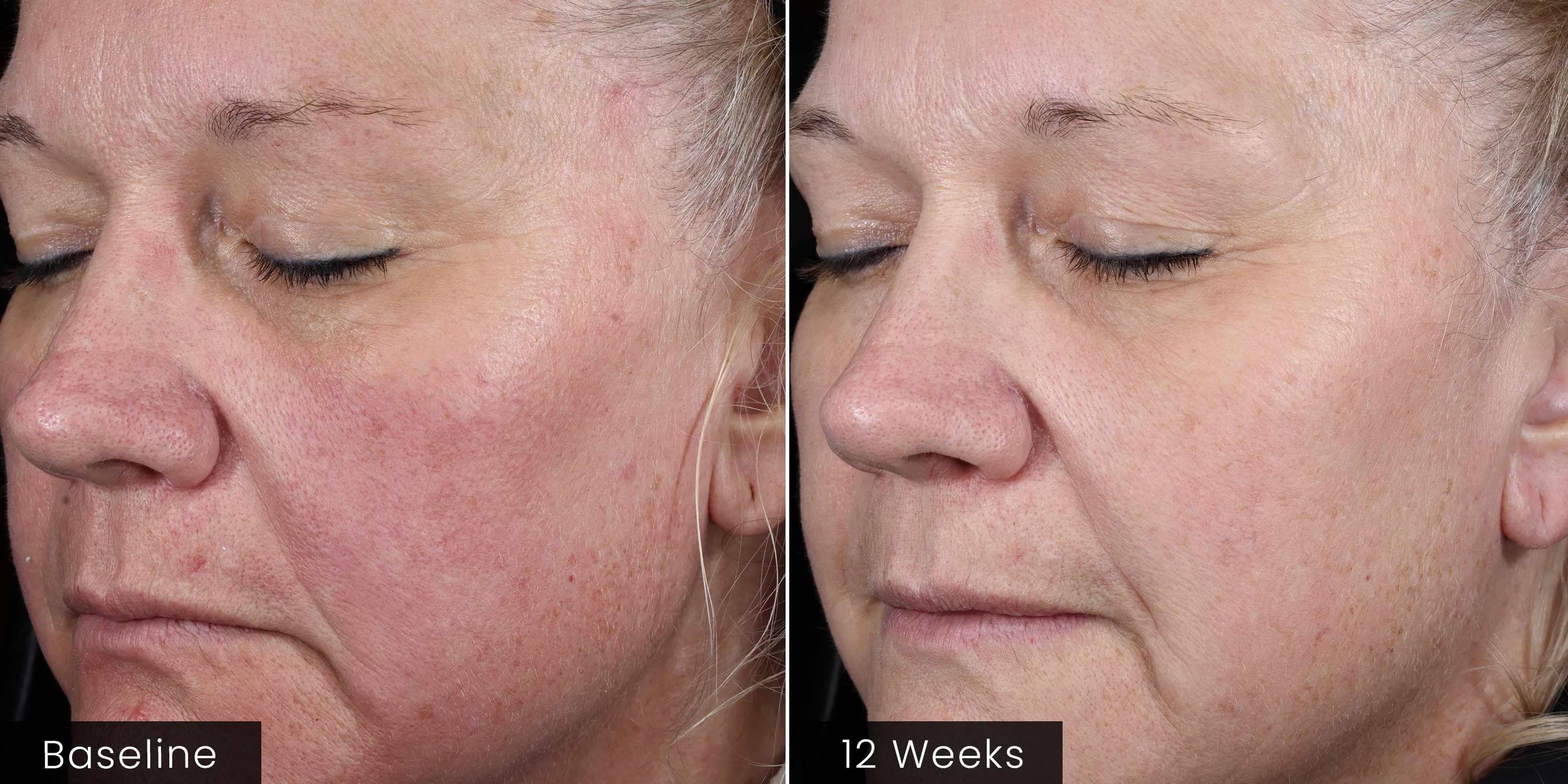 ( plated ) INTENSE Serum before and after results
