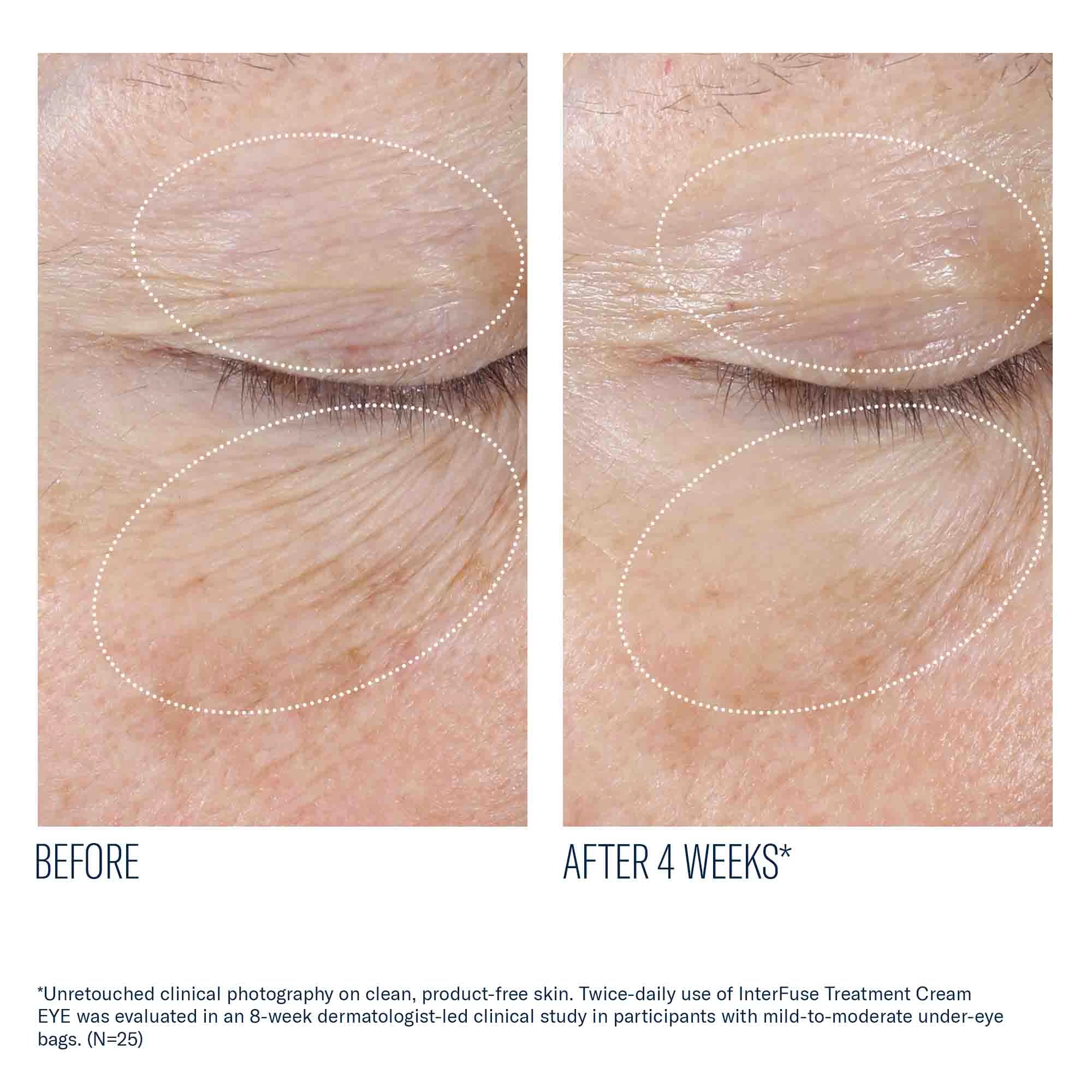 InterFuse Treatment Cream EYE before and after clinical photography