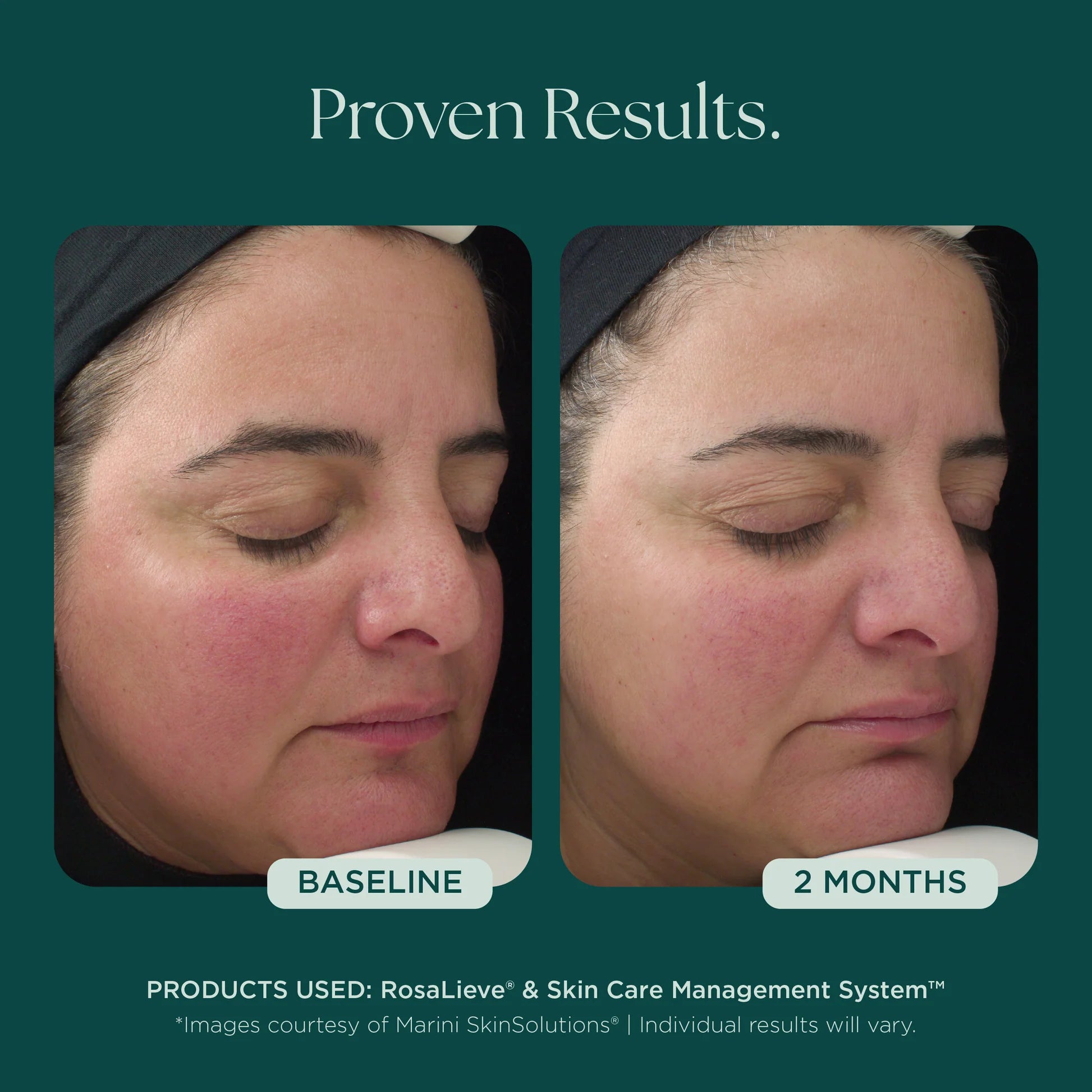 Marini SkinSolutions RosaLieve Redness Reducing Complex, azelaic acid serum that calms visible flushing