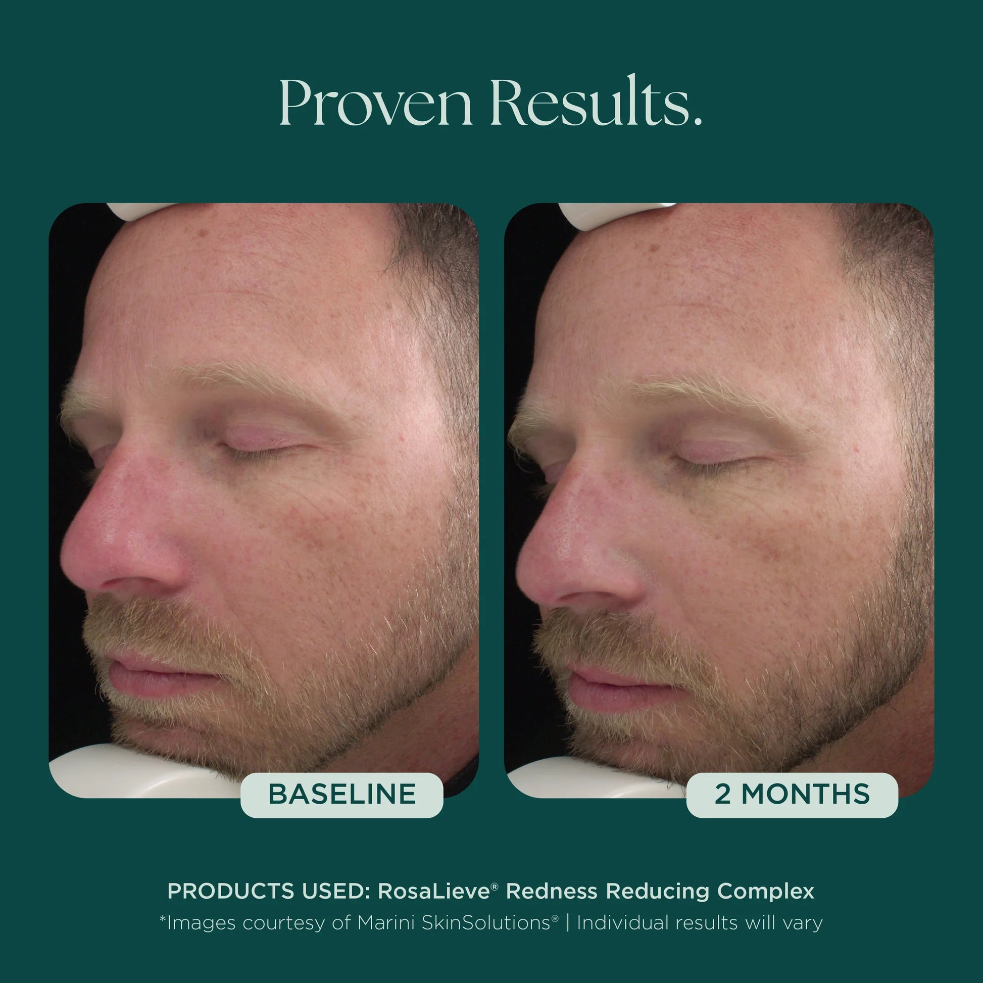 Marini SkinSolutions RosaLieve Redness Reducing Complex, serum, product listing image