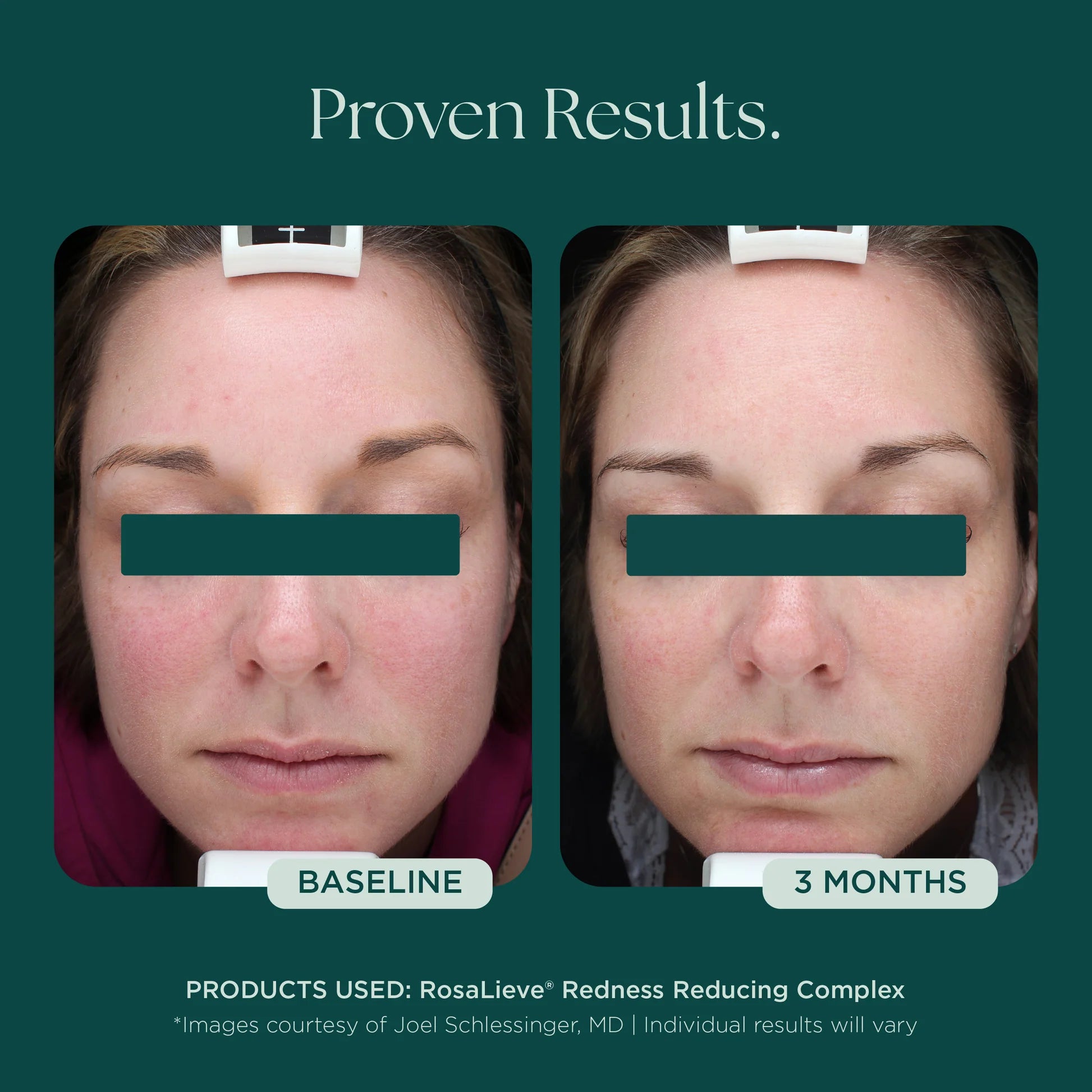 Marini SkinSolutions RosaLieve Redness Reducing Complex, serum, further image from the product listing