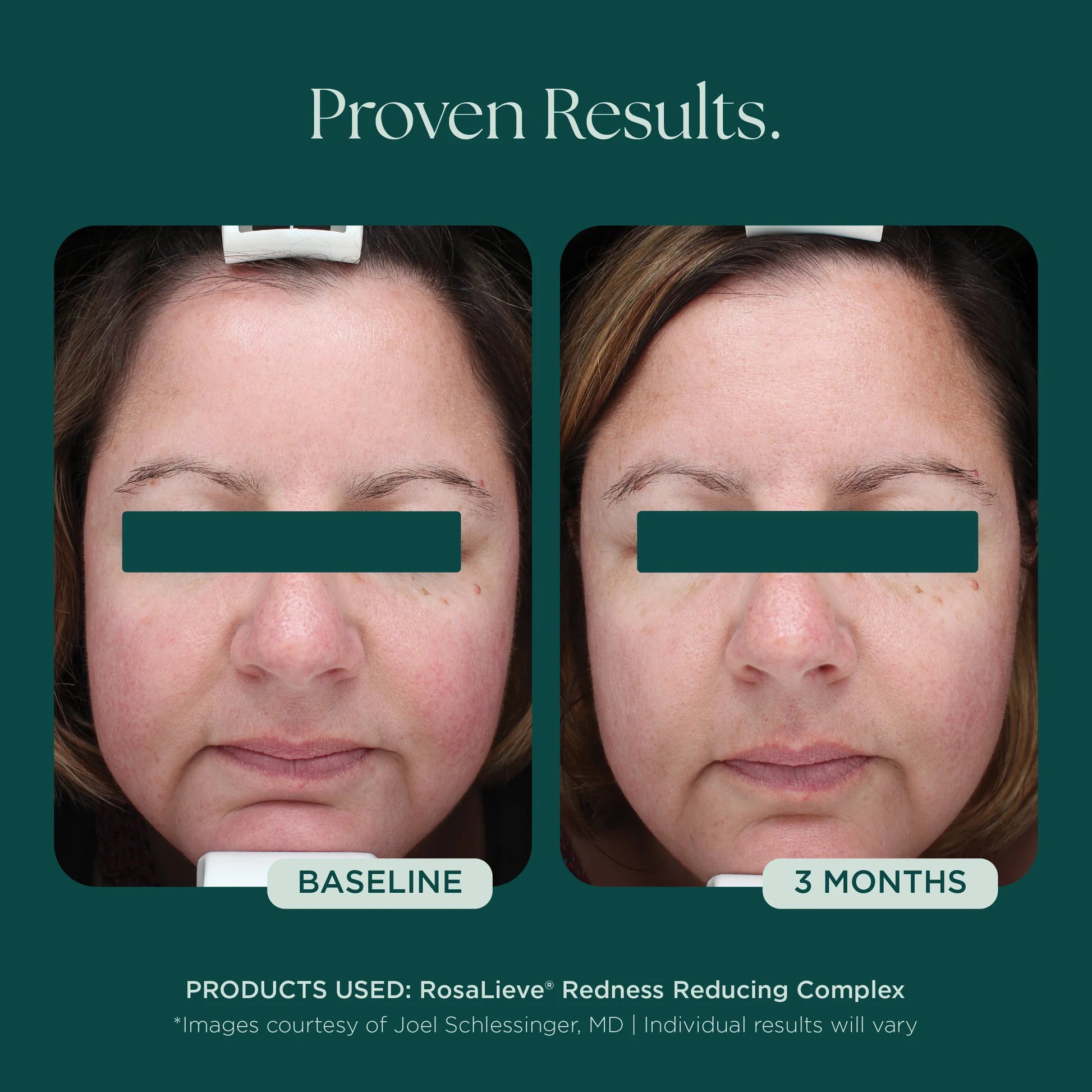 RosaLieve Redness Reducing Complex by Marini SkinSolutions, serum, supporting product image