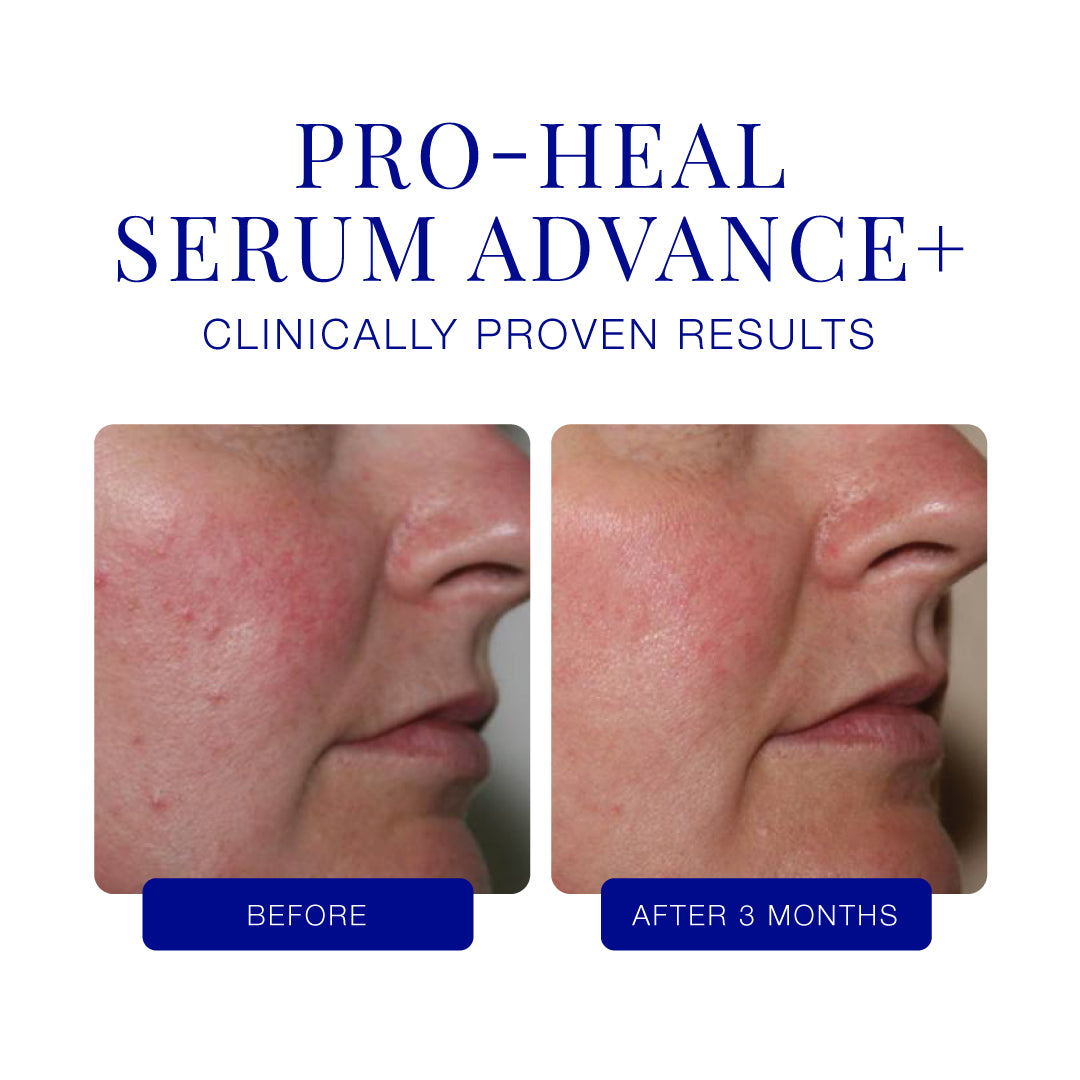 Pro-Heal Serum before and after results