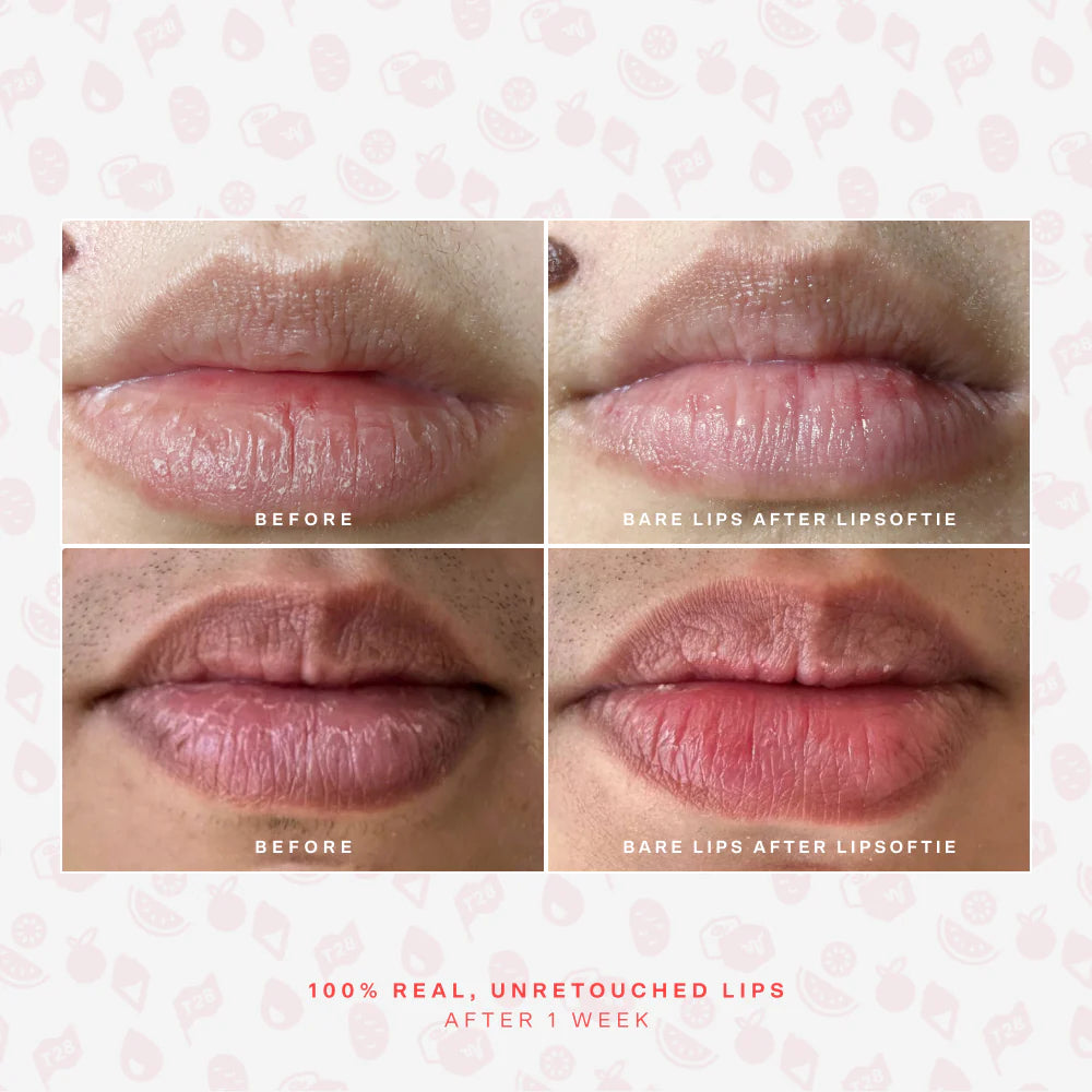 Before and after one week of using SOS LipSoftie Lip Treatment