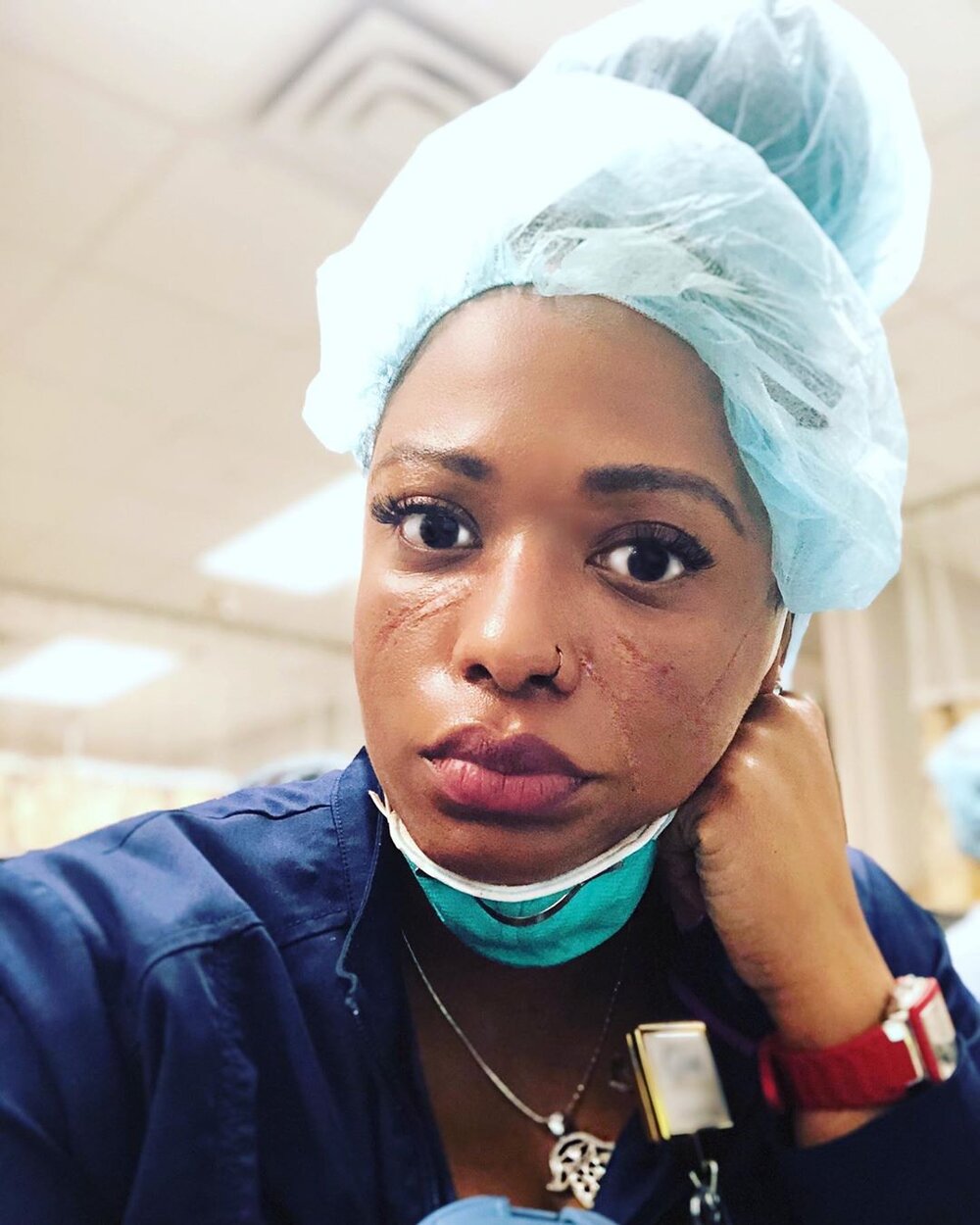 SHAPE: MEDICAL WORKERS ARE SPEAKING OUT ABOUT SKIN BREAKDOWN CAUSED BY TIGHT-FITTING FACE MASKS