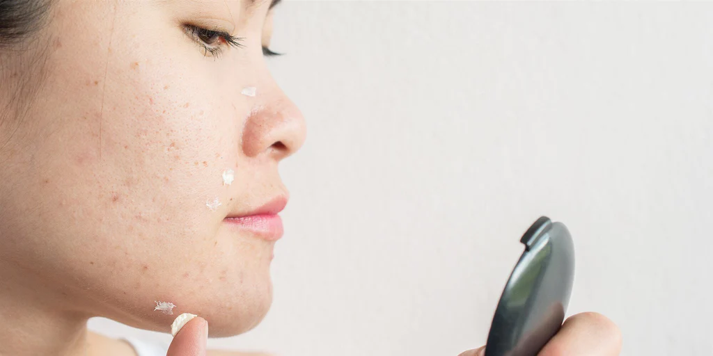 Acne-Prone Skin: What is it, Causes, What to Do, and Prevention