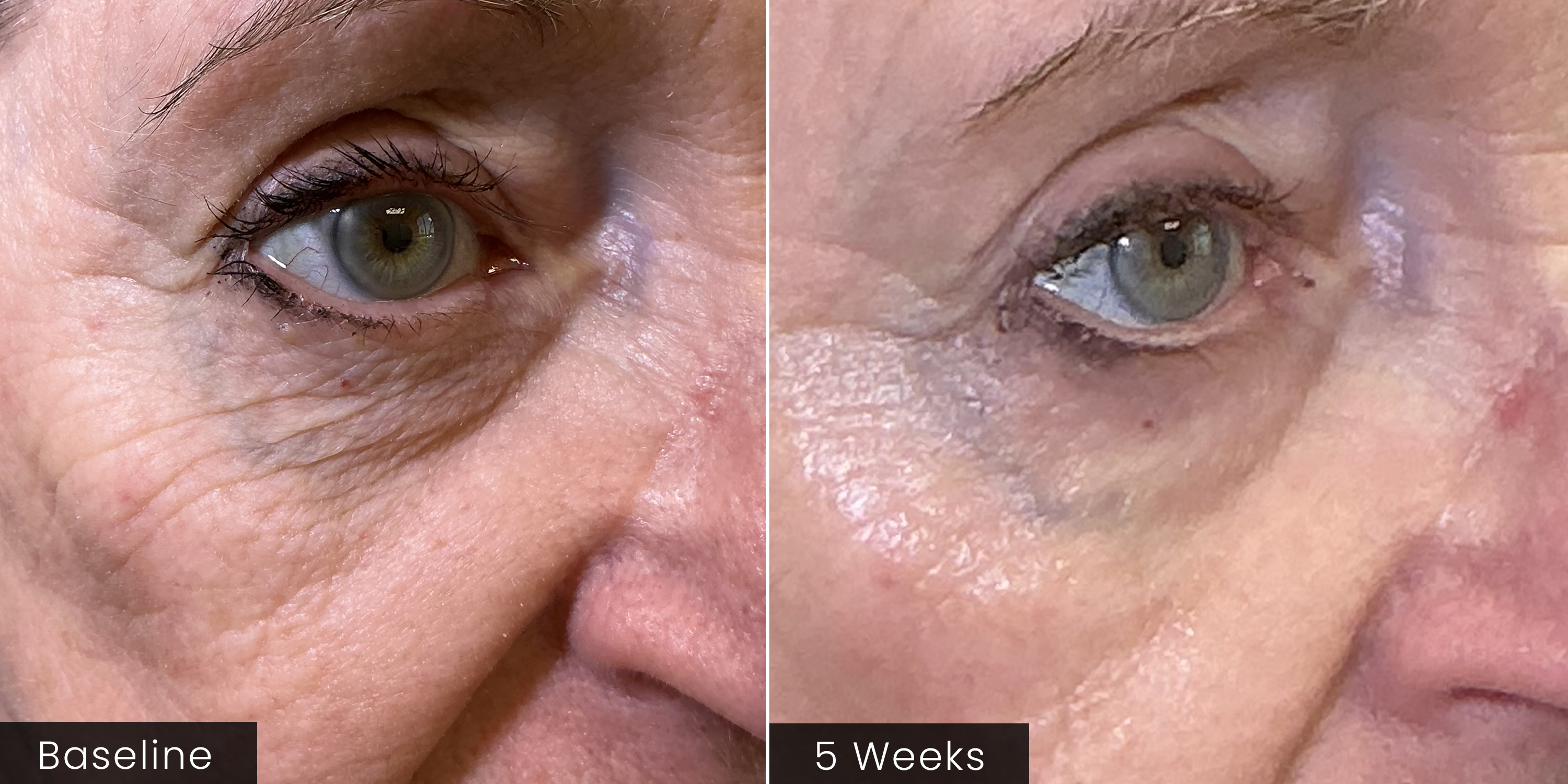 ( plated ) EYE Serum before and after results