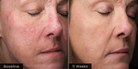( plated ) INTENSE Serum before and after results