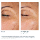 EyeMax AlphaRet Overnight Cream before and after clinical photography
