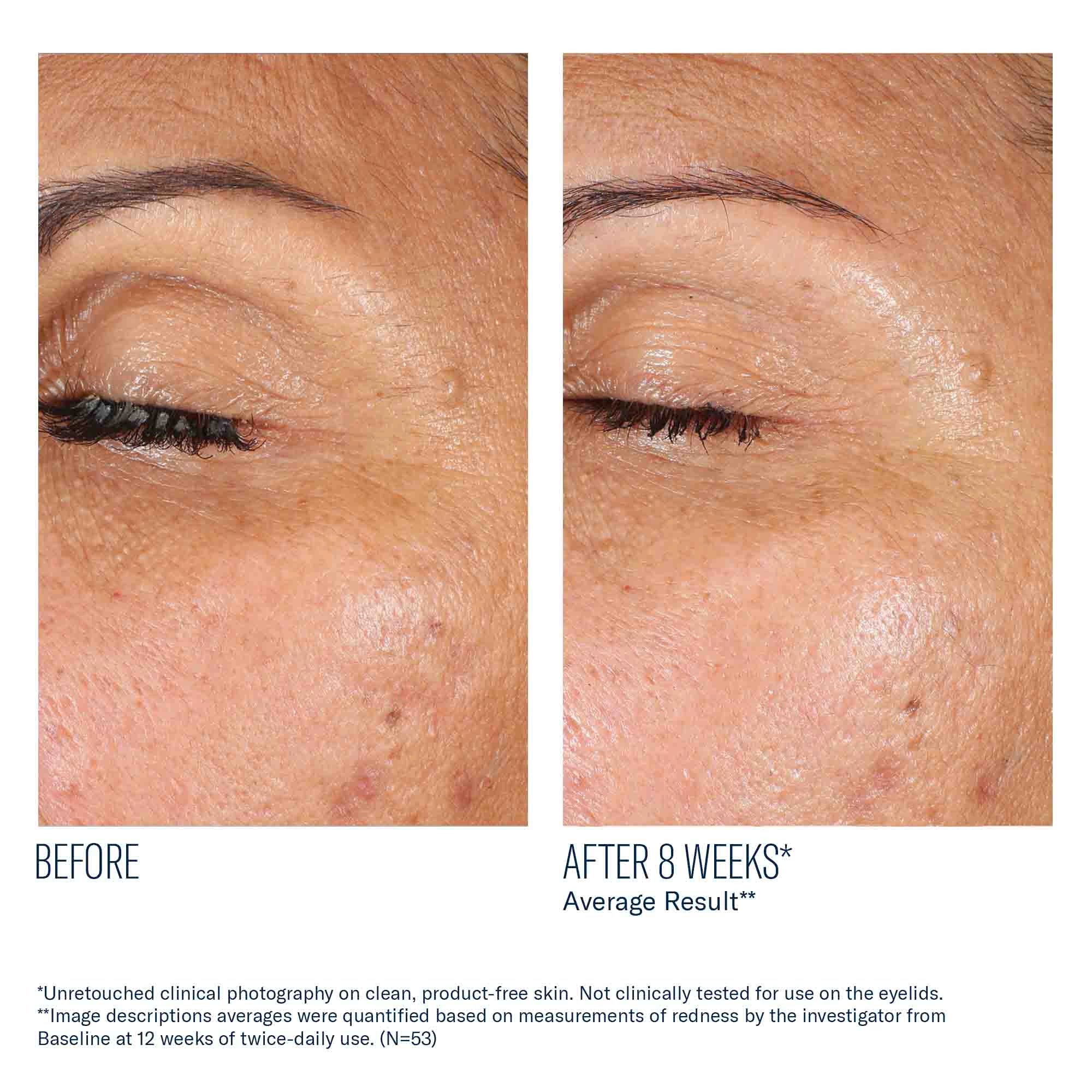 EyeMax AlphaRet Overnight Cream before and after clinical photography